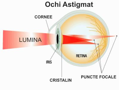 astigmatismul viziunii este că