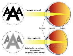 cum să recunoaștem hipermetropia sau miopia